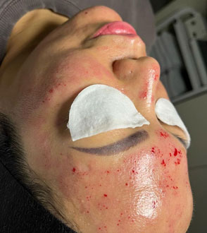 Microneedling immediately post-treatment (sensitive content).