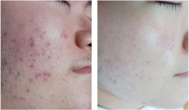 Acne Before
